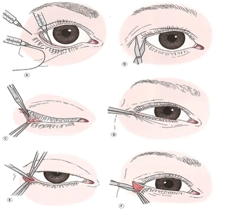 Canthoplasty surgery, a key procedure in oculoplastic surgery, plays a vital role in addressing conditions affecting the lateral canthal complex.