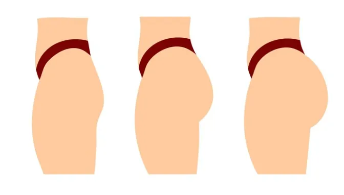 Despite its name, a Brazilian butt lift is not a traditional “lifting” procedure—it does not address loose skin on the buttocks