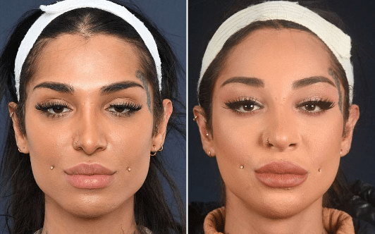 If you're considering Chin shaving surgery or genioplasty, it's important to understand the potential benefits, such as achieving a more defined and proportionate chin