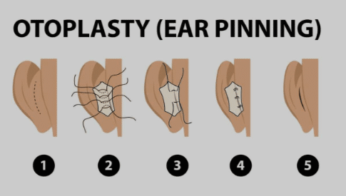 The benefits of otoplasty, a form of ear surgery, extend beyond physical appearance, as it can positively impact an individual's social interactions