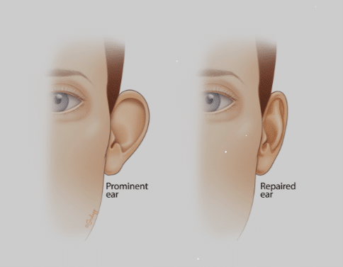 Otoplasty, also known as ear surgery, offers numerous benefits for individuals seeking to enhance their appearance and boost their self-confidence.