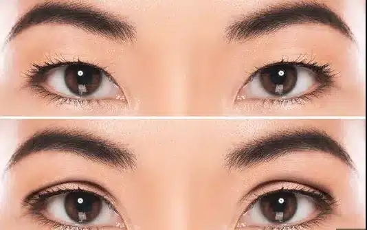 ne of the major benefits of double eyelid surgery is the ability to create a crease that enhances the overall symmetry of the face.