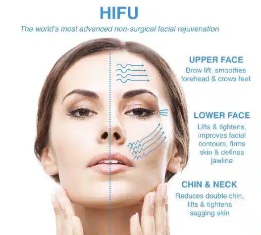 Patients who opt for HIFU facelift can enjoy the benefits of a non-invasive procedure that requires no downtime, enabling them to resume their daily activities immediately