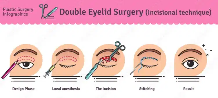 The decision to have double eyelid surgery was driven by both aesthetic desires and the potential advantages it offered.