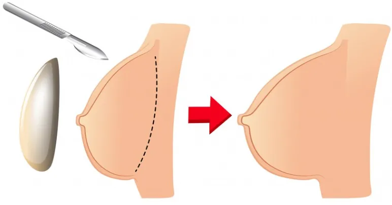 Among the different types of cosmetic surgery for breasts, breast augmentation stands out as a widely sought-after option to enhance breast size and improve overall appearance.
