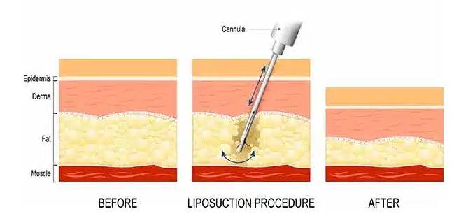 Ultrasound-assisted liposuction (UAL) and laser-assisted liposuction (LAL) are innovative techniques used in lipomatic surgery