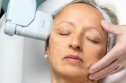 HIFU facelift provides long-lasting benefits, such as improved skin tone and texture, making it a popular choice among individuals seeking a non-surgical solution for skin tightening.