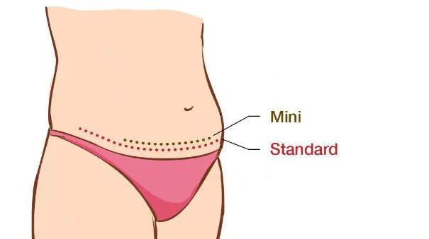 Before undergoing mini abdominoplasty surgery, it is essential to understand the potential risks and complications associated with the procedure.