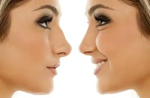 While the cost of a nose job or rhinoplasty can vary depending on different factors, including insurance coverage