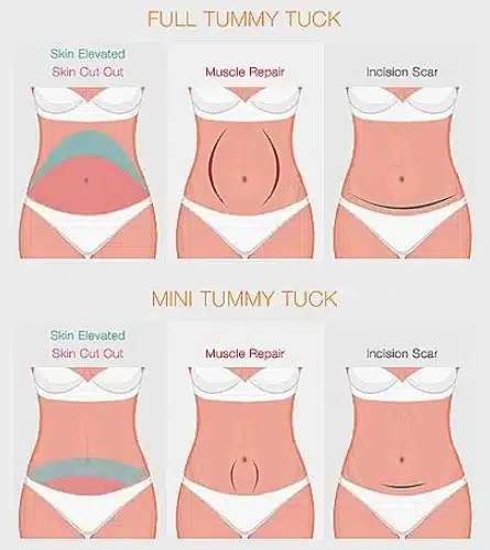 Many individuals opt for mini abdominoplasty surgery to enjoy the long-lasting benefits of a flatter and more toned lower abdomen.