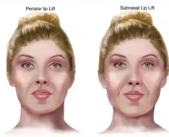 Understanding the benefits of a lip lift can help individuals make informed decisions about whether to undergo this transformative surgery 