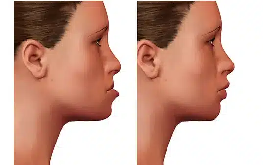 Jaw surgery, or orthognathic surgery, is a transformative procedure that corrects jaw misalignments