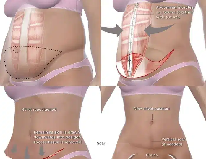 Recovery from both panniculectomy and abdominoplasty requires understanding their differences.
