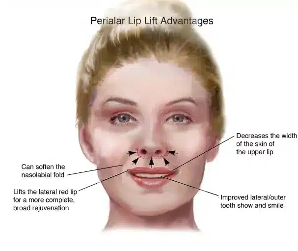 With advancements in lip lift surgery techniques, patients can enjoy the long-lasting benefits of fuller lips and enhanced facial harmony.