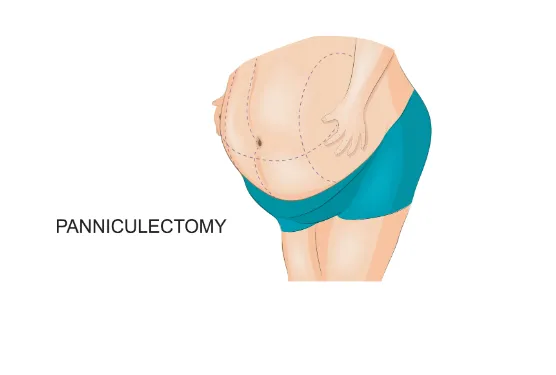 The recovery experiences differ based on the variations between panniculectomy and abdominoplasty.