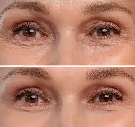 Another benefit of under eye fat transfer is the minimally invasive nature of the procedure