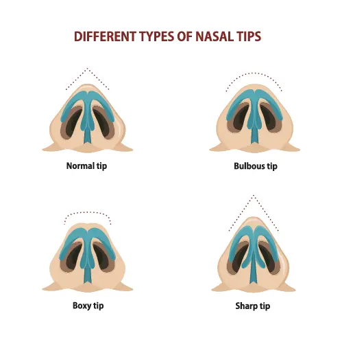 Bulbous nose tip rhinoplasty is a specialized form of rhinoplasty aimed at addressing a prominent or rounded nasal tip.