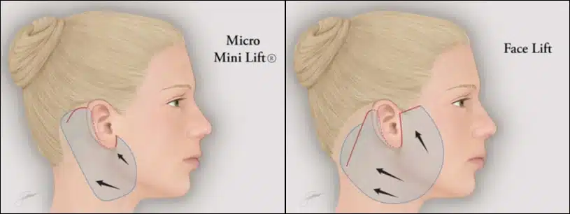 One of the primary advantages of a mini facelift compared to a traditional facelift is its reduced recovery time.