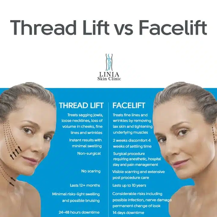 Thread lifts have actually been around since the 1990s, but the materials and techniques used in the procedure have evolved over time, Dr. Alan Matarasso, spokesperson for the American Society of Plastic Surgeons, tells TODAY.com.