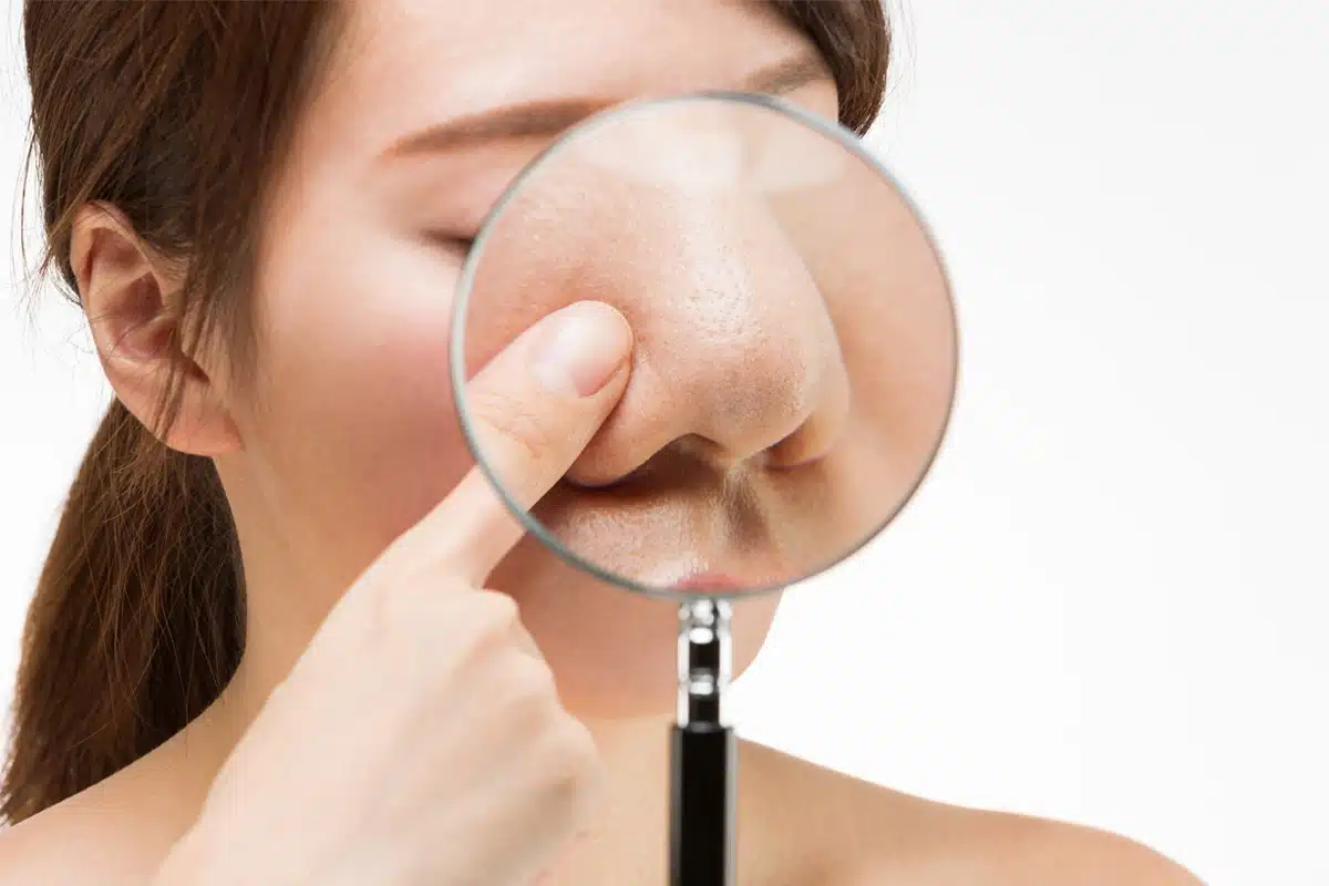 Yes, a bulbous nose tip can be corrected through various surgical and non-surgical interventions, depending on the severity of the condition and the individual's aesthetic goals. Surgical correction typically involves rhinoplasty, specifically targeting the nasal tip to refine its shape and reduce its prominence.