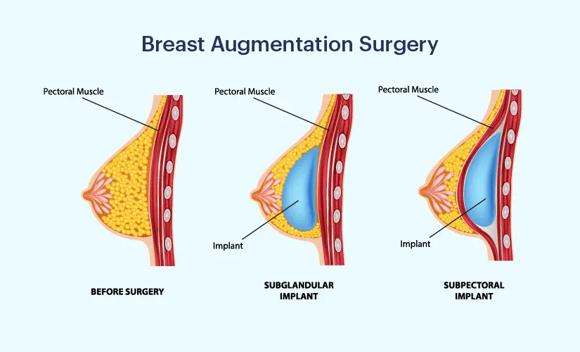 During the first week, patients may need to wear a surgical bra or compression garment to support the breasts and minimize swelling.