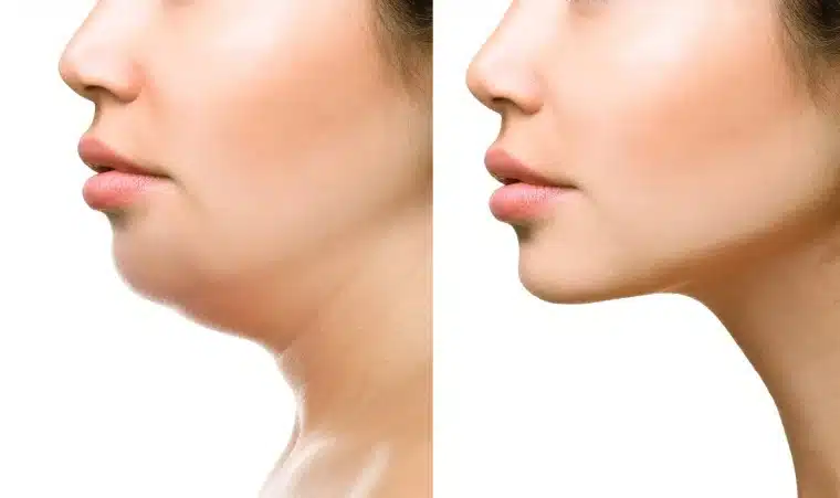 Another application of jaw fillers is jawline asymmetry correction. Many individuals have asymmetrical features, including the jawline, which can affect overall facial harmony.