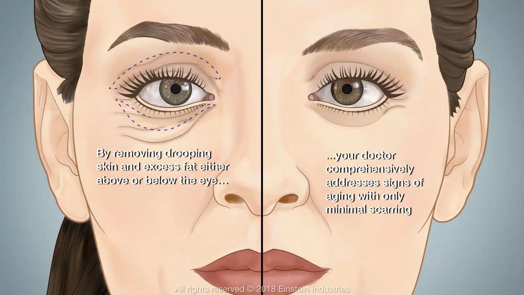 The first step in blepharoplasty involves administering anesthesia to ensure the patient's comfort during the procedure.