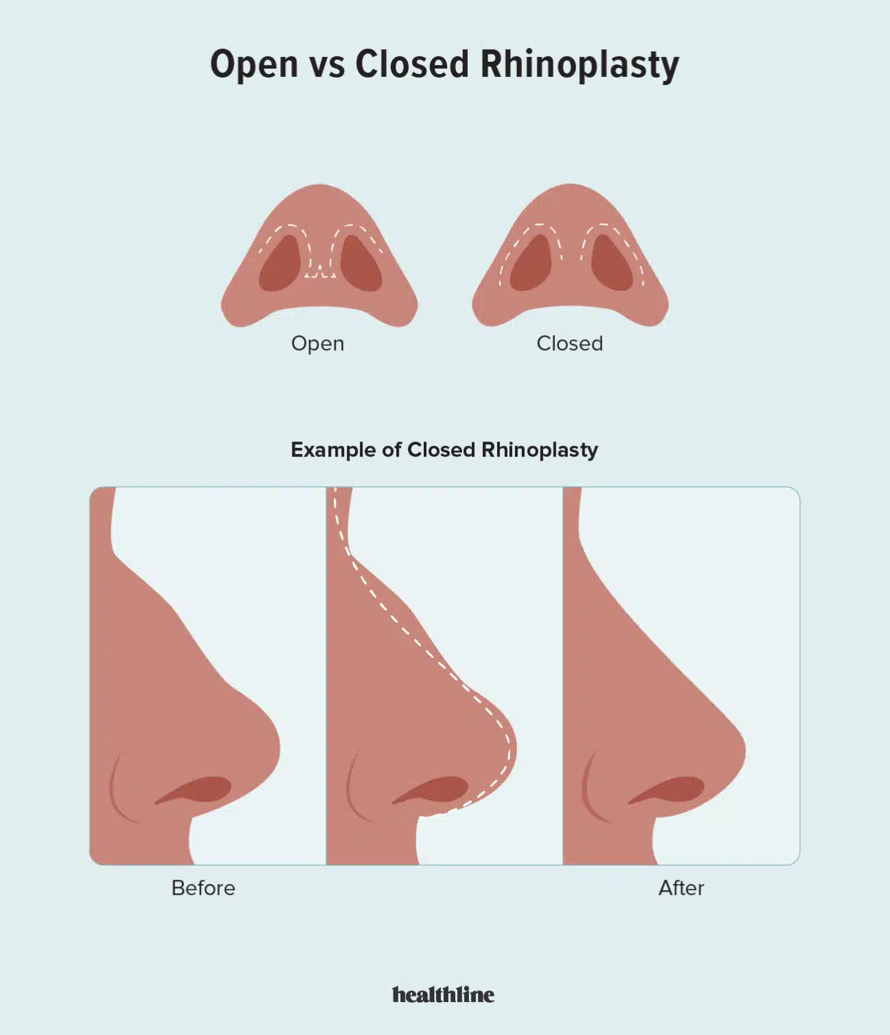 While all surgical procedures have inherent risks, some parts of rhinoplasty are more delicate and have higher associated risks.