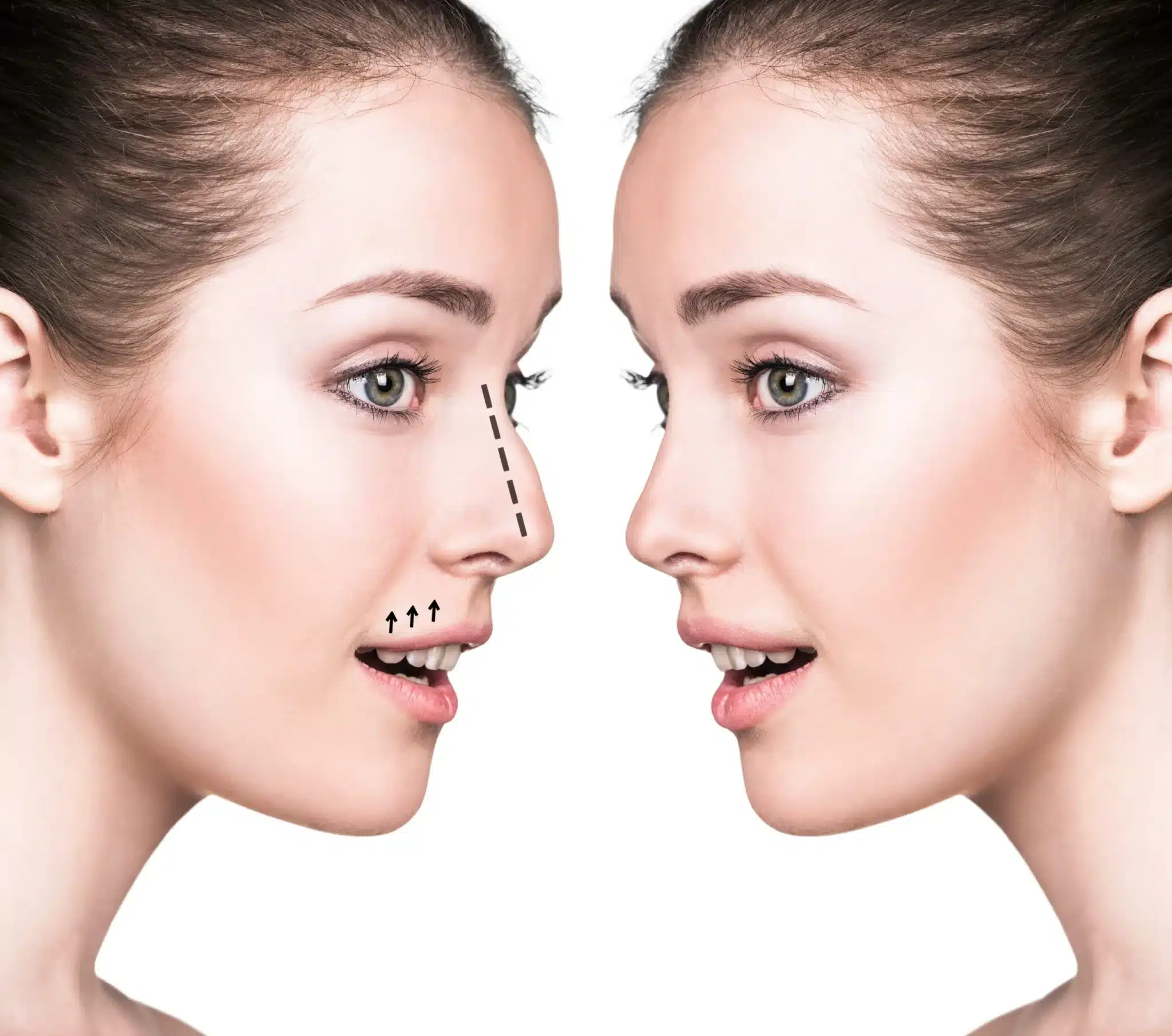 Another consideration with rhinoplasty is the recovery process, which can vary depending on the extent of the procedure and individual healing factors.
