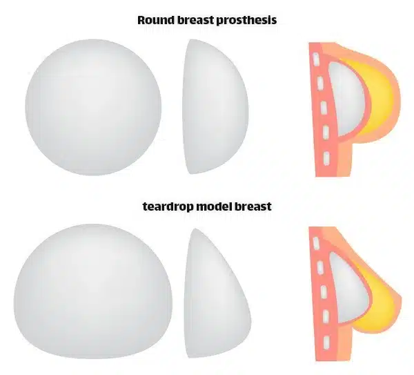 Current research and action related to Breast Implant Illness (BII) are focusing on better understanding the potential link between breast implants and systemic symptoms reported by some patients.