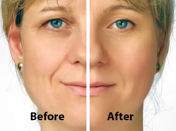 If you opt for lower eyelid surgery (lower blepharoplasty), you can expect your results to last for a lifetime.