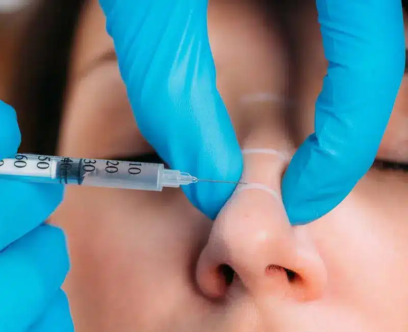 10 years ago, only the brave went under the knife for rhinoplasty. Now, non-surgical ‘liquid nose jobs’ are booming with their promise of a straighter, more defined nose with next-to-no downtime and at a fraction of the cost.