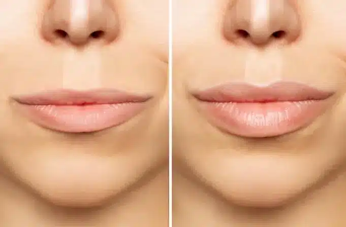 While the benefits of lip augmentation include enhanced confidence and a youthful appearance, it's important to consider the potential risks of lip augmentation such as swelling