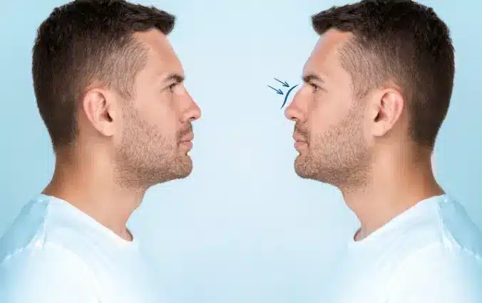 Before undergoing cosmetic surgery, one should research the risks of a nose job.