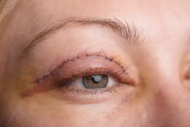 It's crucial for patients to understand the differentiation between the base cost of blepharoplasty and the factors that can result in the increased cost of blepharoplasty.