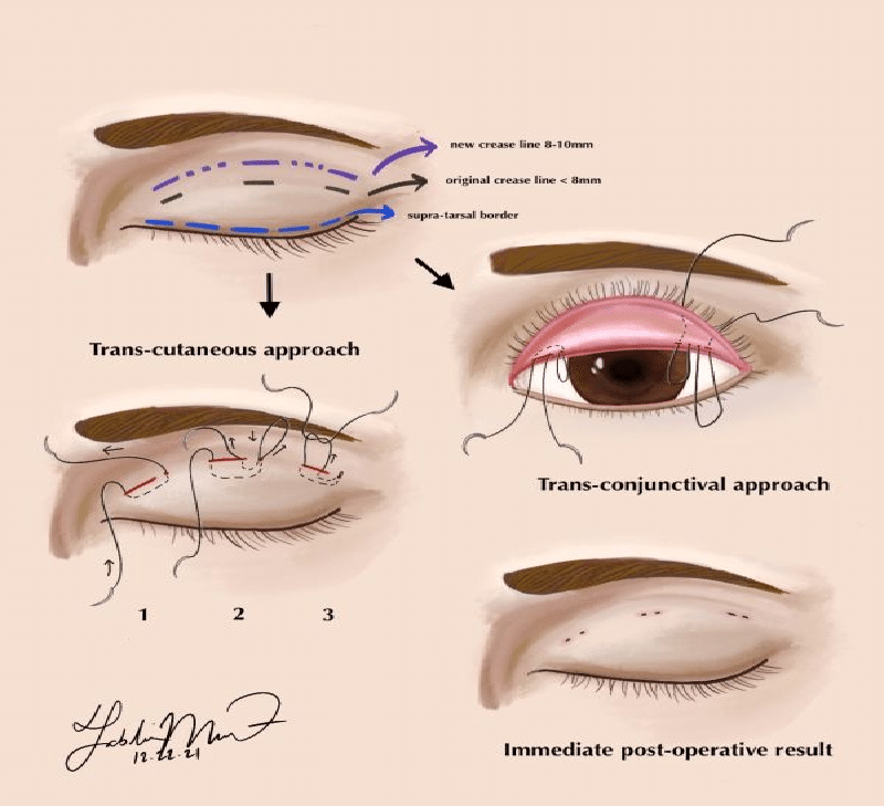 Known to the medical community as blepharoplasty, eyelid surgery is meticulously designed to correct drooping or sagging eyelids, making it distinct from its counterpart, the brow lift.